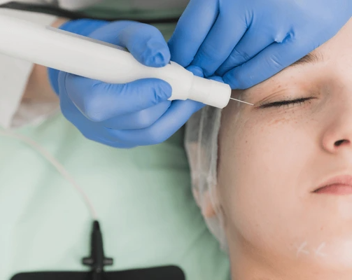 Plasma Eye Pen Treatment